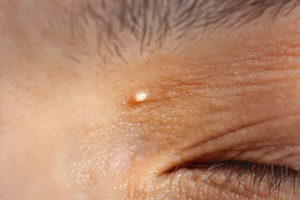 眼睛周围长得这些小颗粒 到底是什么啊啊啊啊？