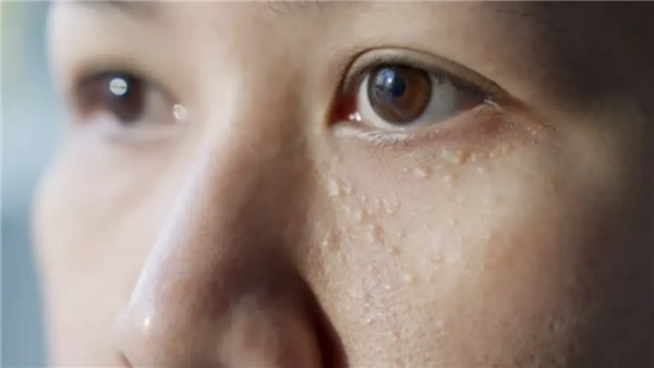 眼睛周围长得这些小颗粒 到底是什么啊啊啊啊？